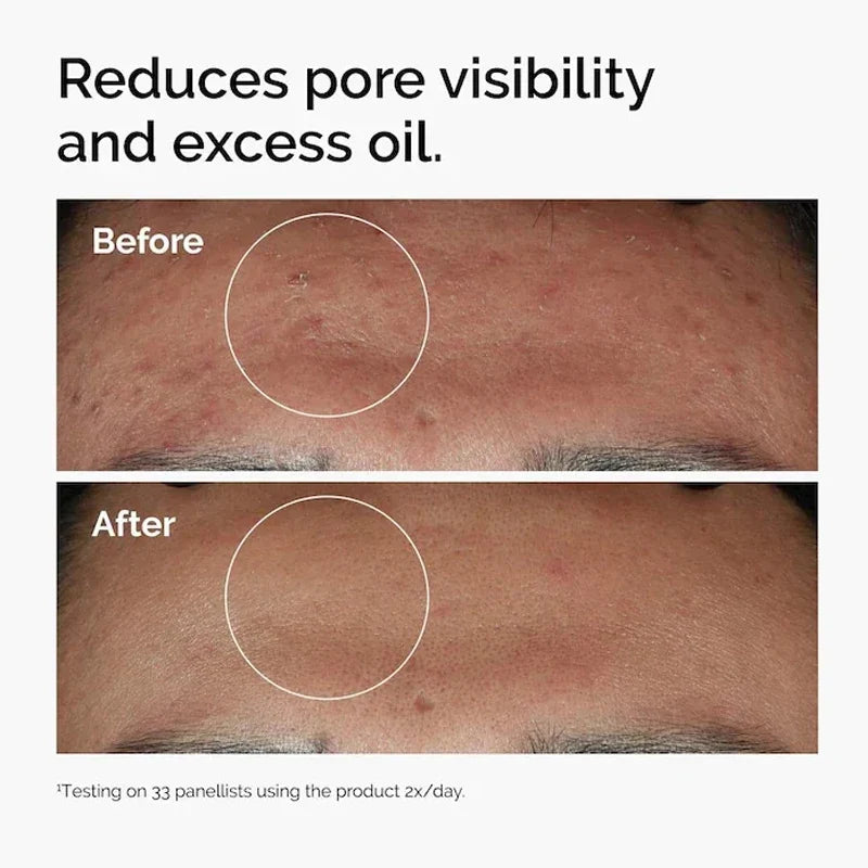 The Ordinary Niacinamide 10% + Zinc 1% Serum results 